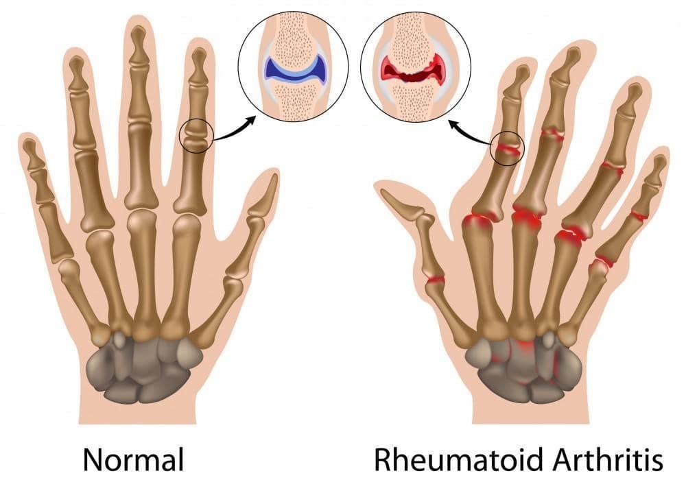 What is Rheumatoid Arthritis?