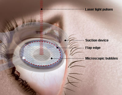 Cara Kerja LASIK Mata