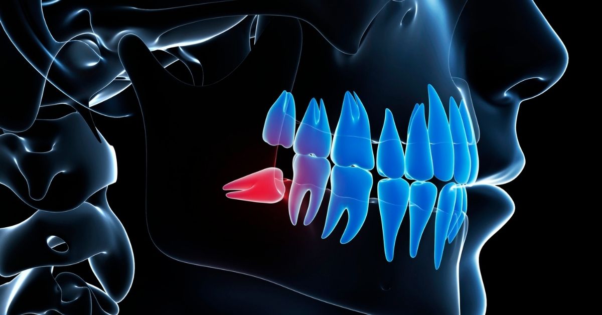 Understanding Wisdom Teeth.jpg