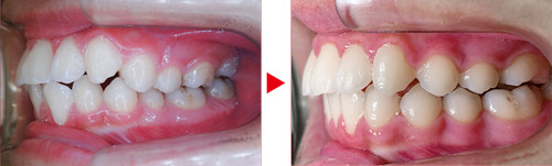 症例03矯正写真（左）、治療前→治療後