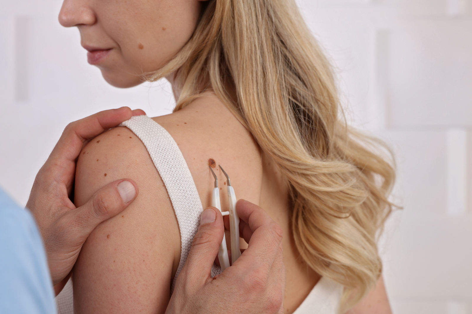 Dermatologist inspecting a skin tag on a woman's shoulder during professional removal consultation