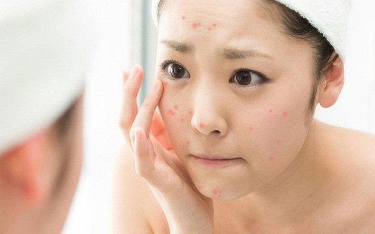 Cần có chế độ chăm sóc đặc biệt cho làn da dầu mụn nhạy cảm