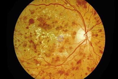 Understand the Four Stages of Diabetic Retinopathy