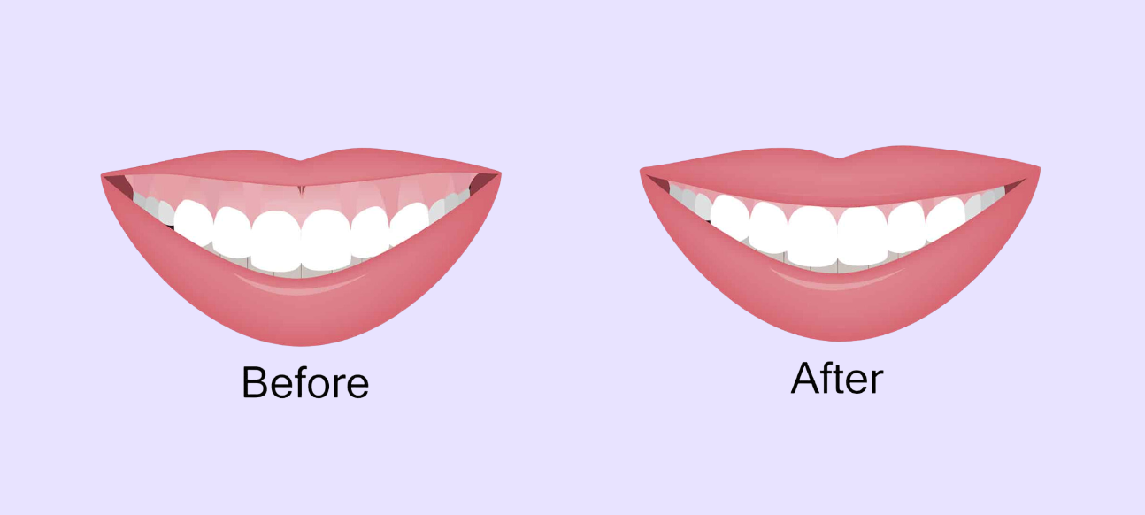 Gumlift before and after