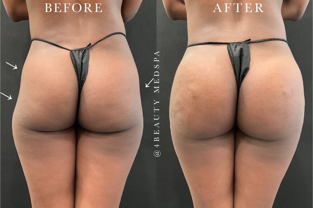 Before & after of a Non Surgical BBL