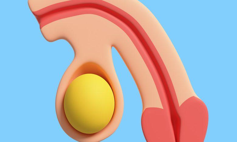 O que é a Doença de Peyronie? - urologia, Urologista Goiânia, Dr. Breiner  Ferro, Urologia Goiânia, medico urologista, clinica urologia, clinica  urologista, hospital urologia, hospital urologista, hospital urologico,  medico urologista, Urologista Goiás,