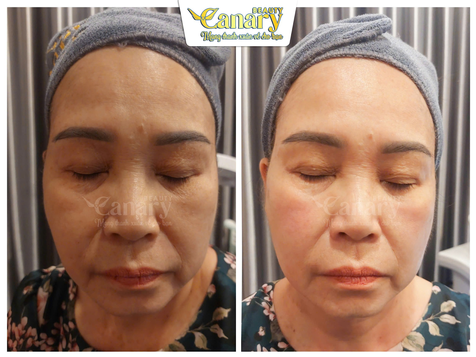Đối tượng nên thực hiện meso không kim