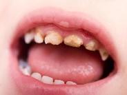 Close-up of a child's mouth with teeth and gums

Description automatically generated