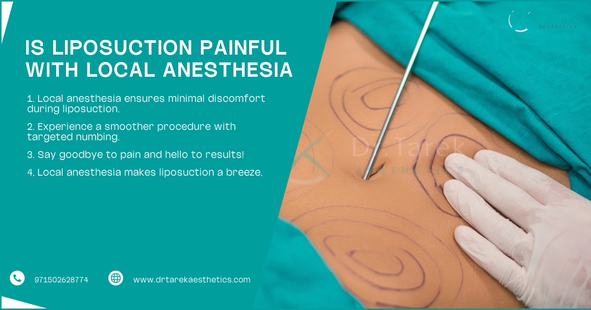 Can Liposuction Be Done Under Local Anesthesia