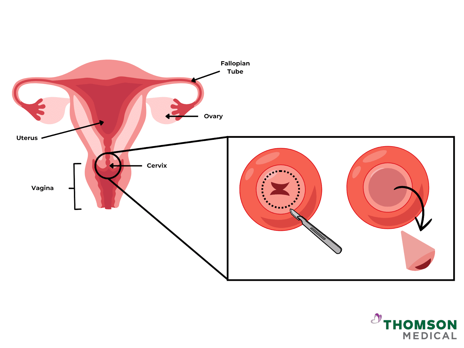 Cone biopsy procedure