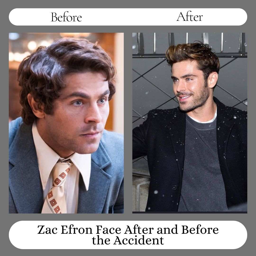 Zac Efron Face After and Before the Accident