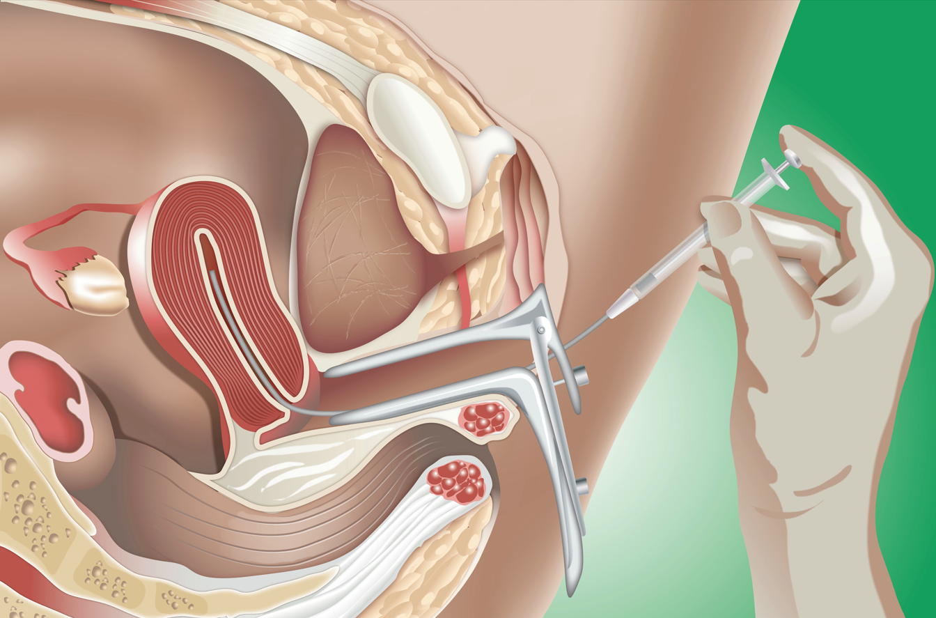 inseminacia