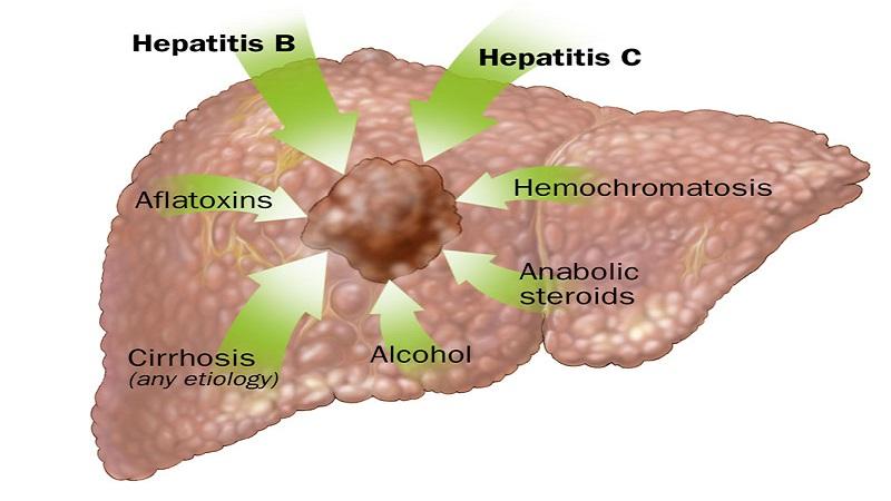 Image result for Causes of Liver Cancer