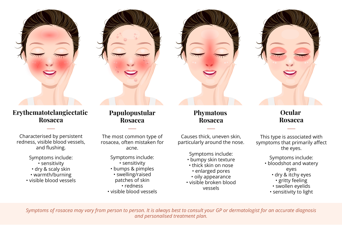 A summary of the four types of rosacea discussed above with a visual presentation of the areas involved.