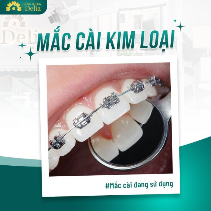 Niềng răng là một phương pháp điều trị nha khoa được sử dụng rộng rãi để giải quyết các vấn đề về răng mọc lệch lạc