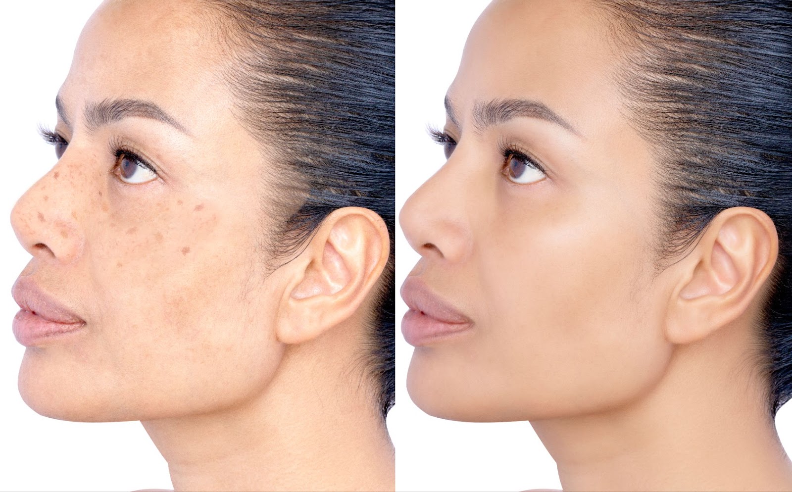 Before and after image of a woman's face showing visible improvement in melasma after treatment.
