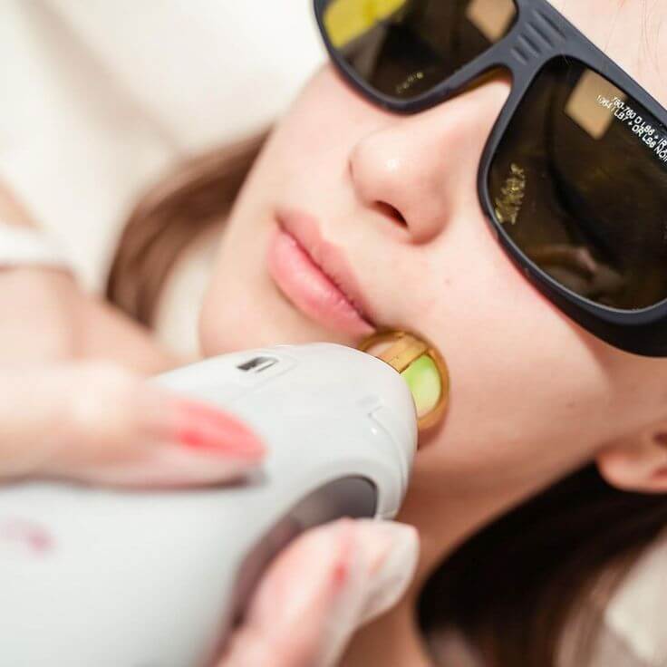 Picture of laser hair removal done on a lady. The laser device is placed close to the lady's mouth.