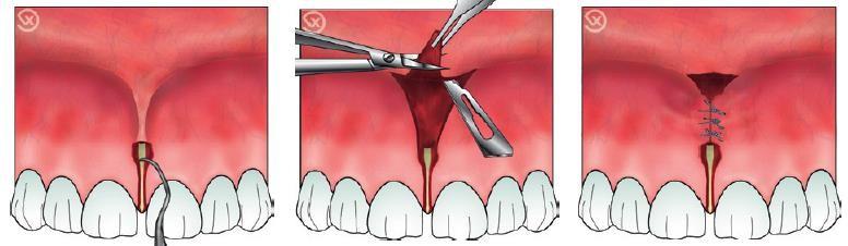 C:\Users\DELL\Pictures\frenectomy 1.png