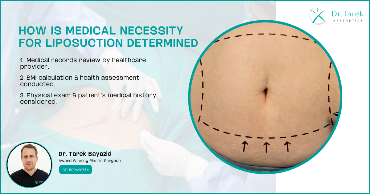 Can Liposuction Be Medically Necessary