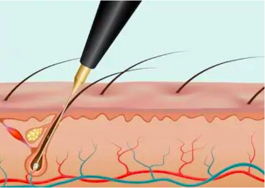 This contain a diagram of hair follicles 