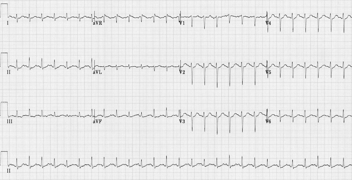 A graph of a heart beat

AI-generated content may be incorrect.
