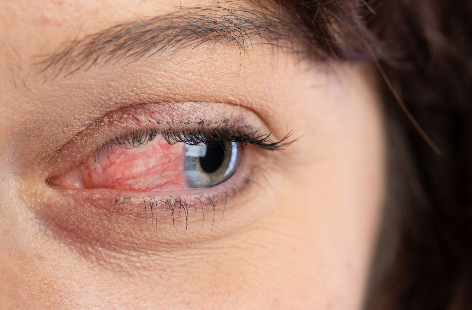 A close-up of a person's eye, the whites are red due to ocular rosacea.