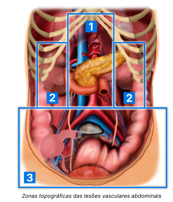 Zonas topográficas das lesões vasculares abdominais