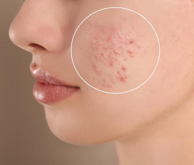 Acne scars 