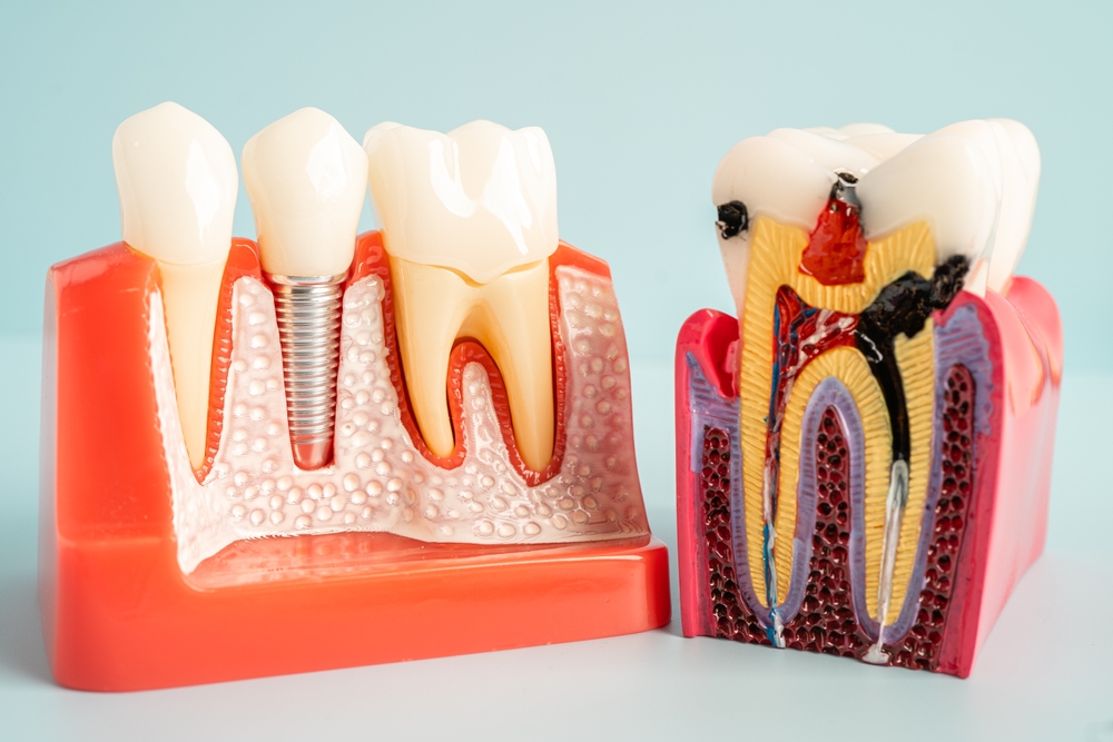 common causes of root canal