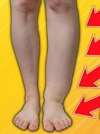 swelling leg