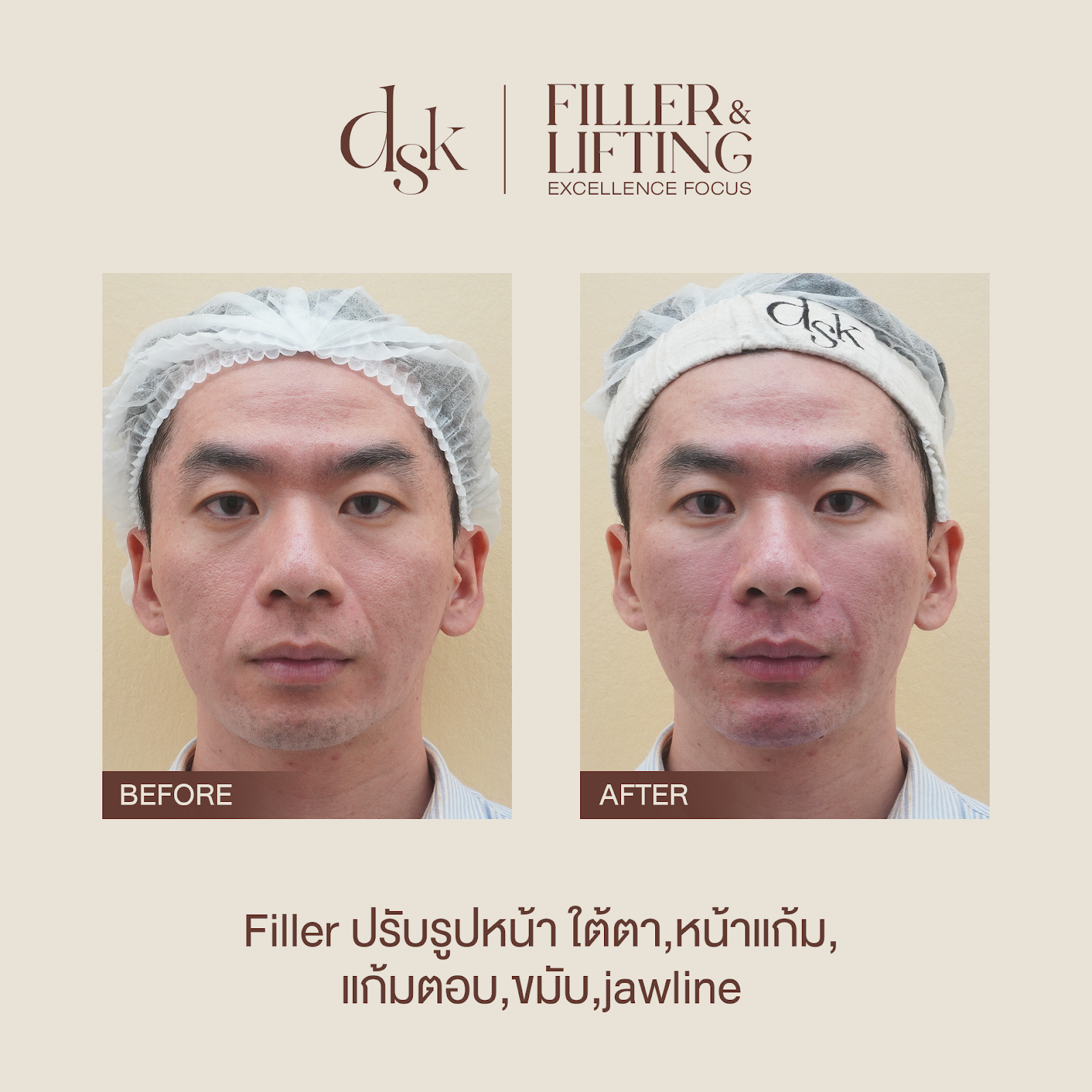 รีวิวฟิลเลอร์แก้มตอบที่ DSK Clinic