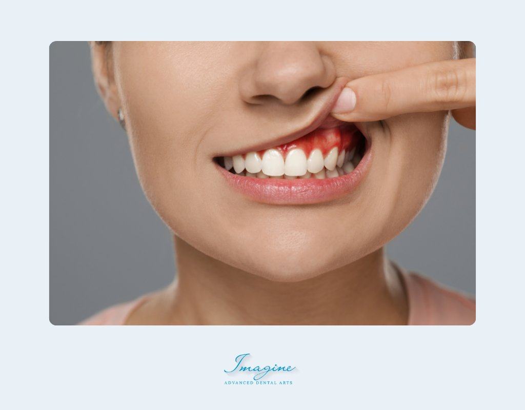 What Is Gingivitis?