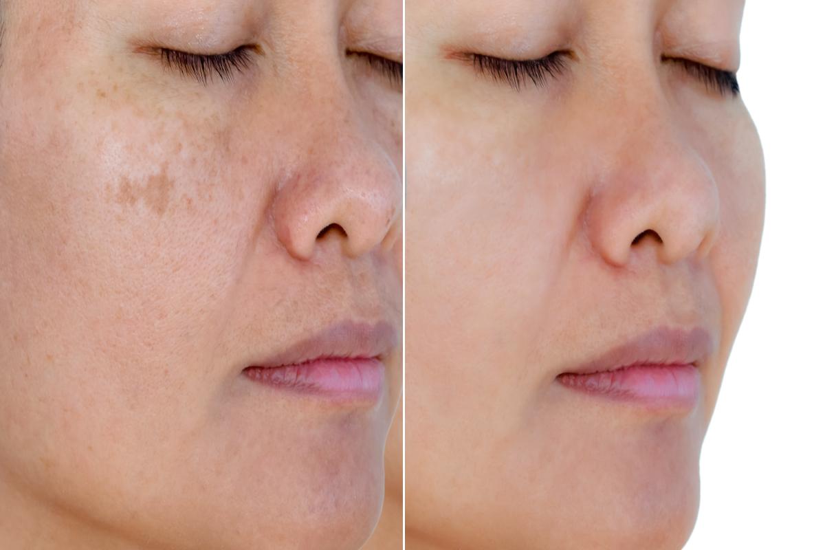Melasma - simptome si caracteristici_femeie, pete pigmentare