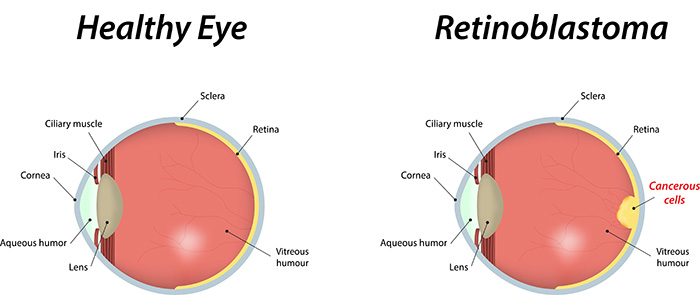 Image of a healthy eye and an eye with retinoblastoma