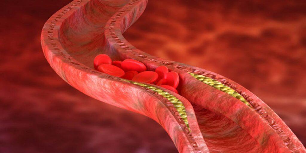 Angioplastia: Cuidados Pós-Cirúrgico e Dicas para o Retorno das Atividades  Diárias 