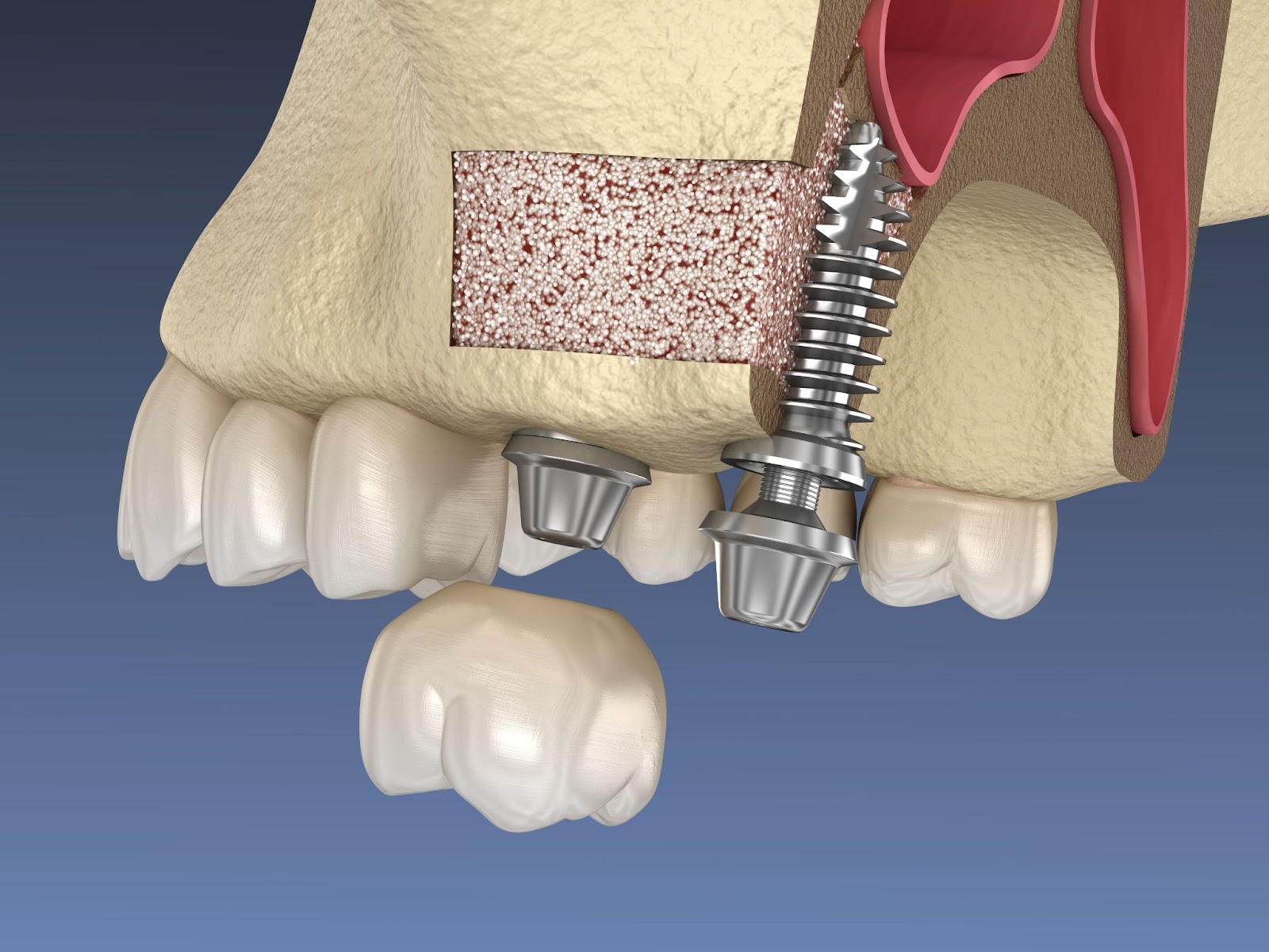 augmentarea sinusurilor maxilare