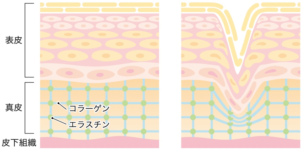 ダメージを受けた真皮層のイメージ