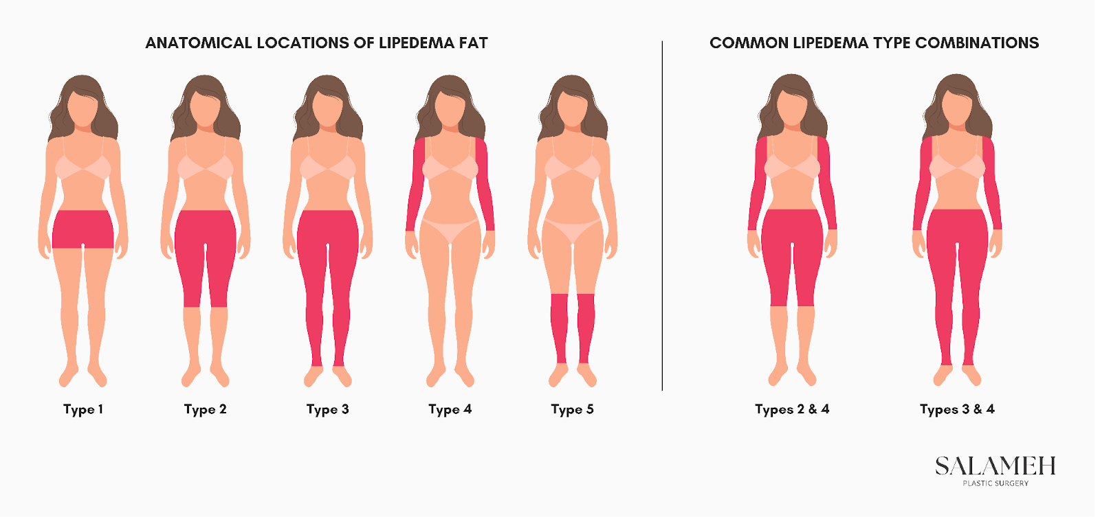 A photo showing the types of Lipedema and the anatomical locations of lipedema fat. It also shows common lipedema type combinations.