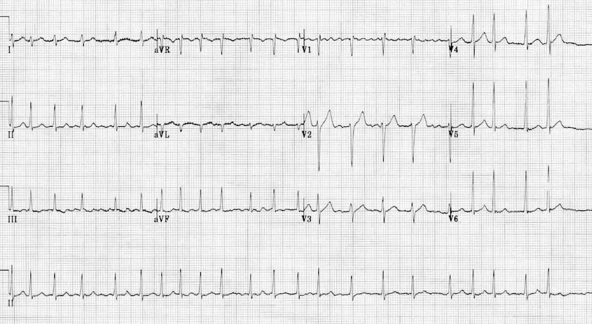 Atrial Fibrillation • LITFL • ECG Library Diagnosis
