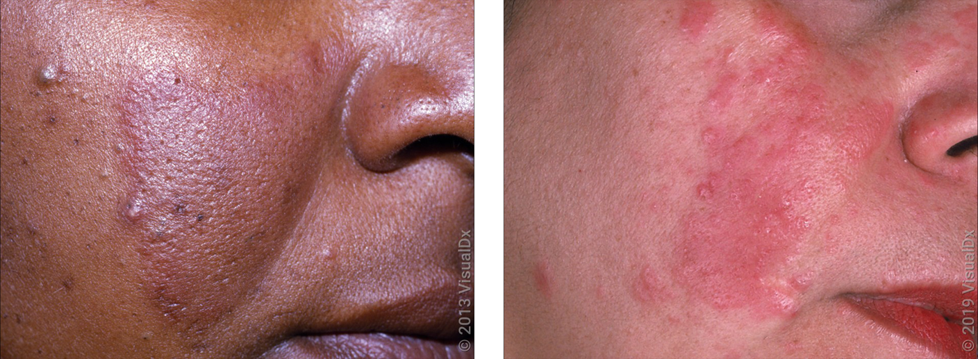 An image illustrating the distinct ways rosacea manifests on dark (left) and fair (right) skin tones. 