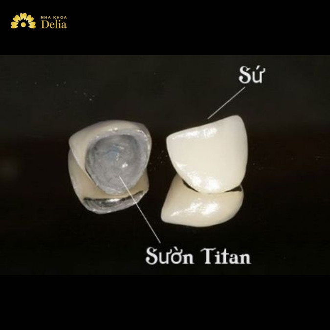 Răng sứ Titan