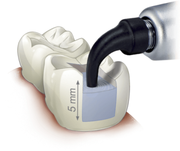 Sistema de composite dental de relleno masivo SonicFill™ 2 Single-Fill™ | Restauración dental con adhesivo Kerr: principio y técnica