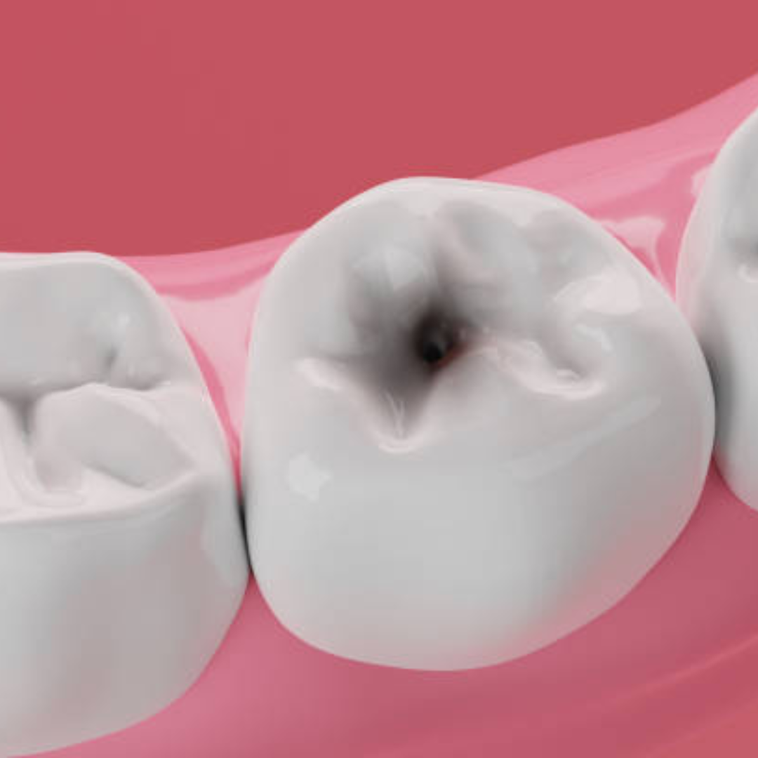 Define Cavity: A Comprehensive Guide for Boston Residents