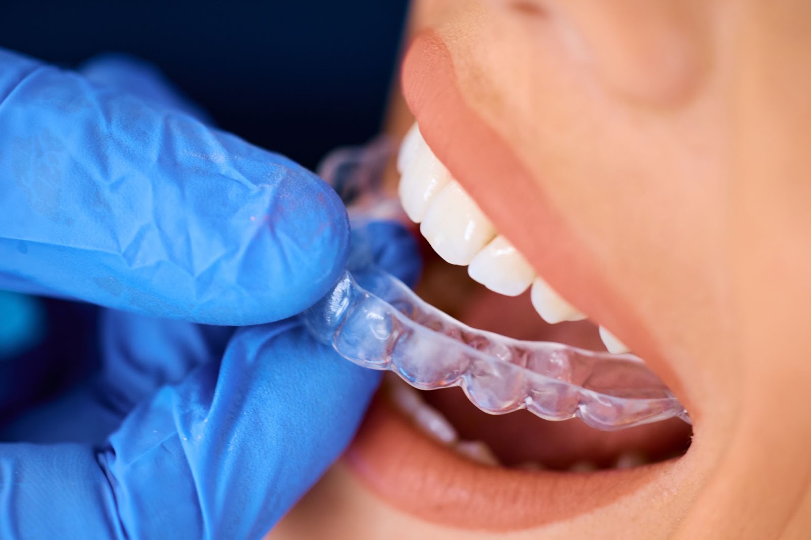 A close-up of a female patient receiving a dental clear aligner.