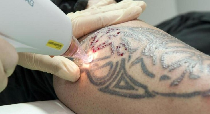 in this image the person is getting his tattoo removal with laser method at Renew You Clinic by https://renewyou.co.in/