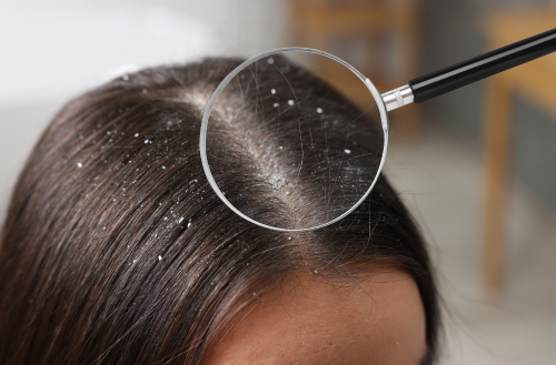 How Effective Is Coconut Oil in Treating Dandruff?