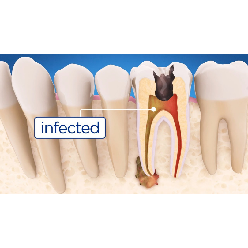Top 8 Root Canal Treatment Side Effects Explained