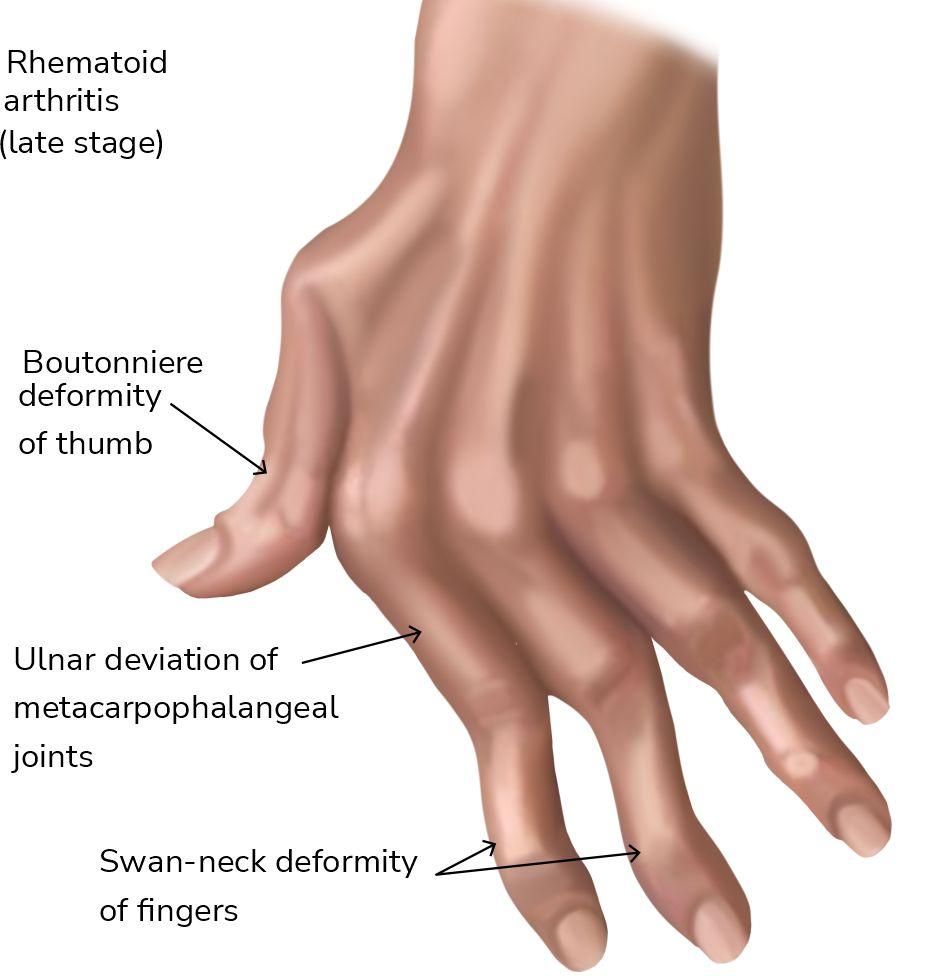 Typical Deformities of RA fingers