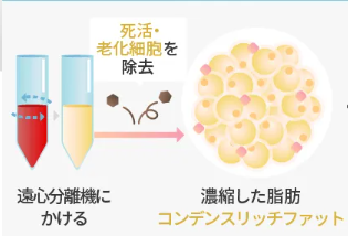 コンデンスリッチ脂肪注入