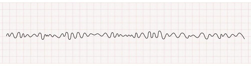 EKG Monitor Showing Ventricular Fibrillation or VF 20203441 Vector ...